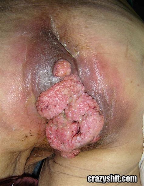std pussy 93775 of all infected with genital warts have ot