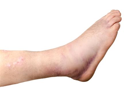 broken ankle foot doctor marietta  atlanta area read