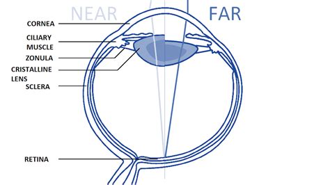 studying presbyopia   optomechanical model   human eye comsol blog