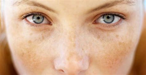 Everything You Need To Know About Freckles Dermmedica