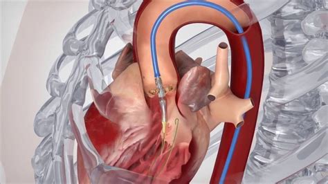 Is Valve Replacement Open Heart Medcoo