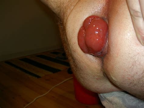 I Pumped Up My Ass Hole 38 Pics Xhamster