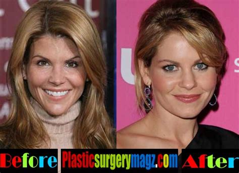 Lori Loughlin Plastic Surgery Before And After Plastic