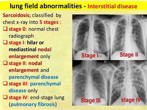 Lung Field Abnormalities Interstitial Disease Sarcoidosis Classified
