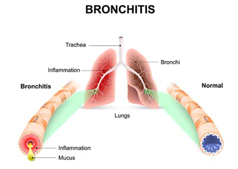chronic bronchitis copd conditions