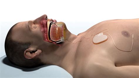 Cms Contractors Propose Lcd Payments For Inspire Medical’s Sleep Apnea