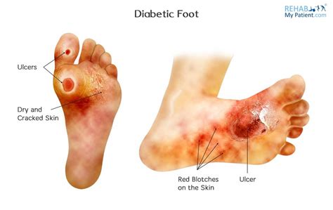 diabetic charcot foot rehab  patient