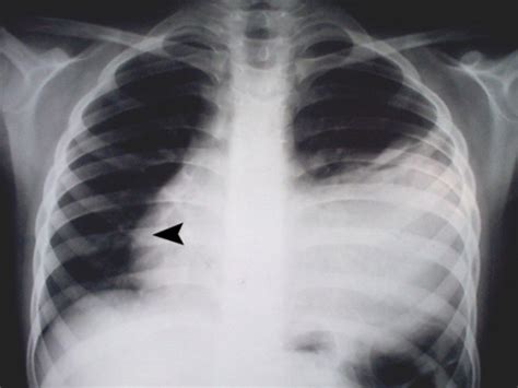The Pa Chest X Ray Left Sided Pleural Effusion And A L Open I