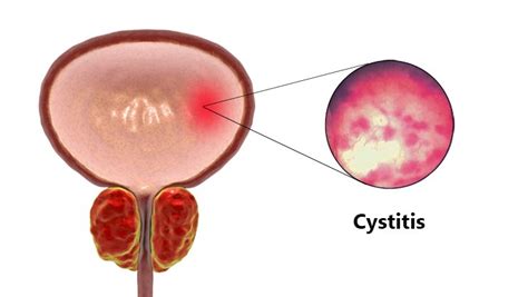 cystitis causes symptoms risk factors treatment and prevention
