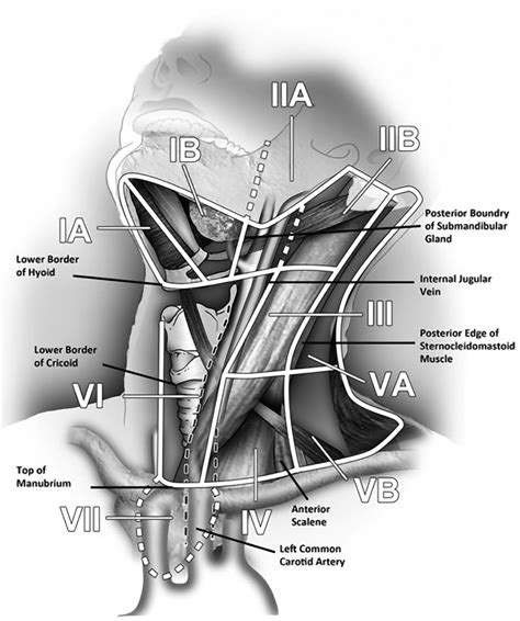 Lymph Node Dissection Radiology Key
