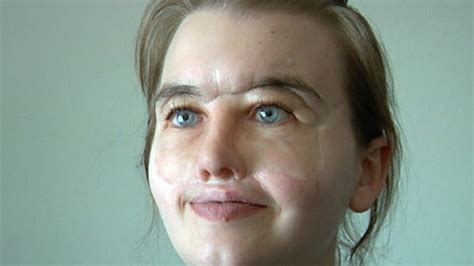 chrissy steltz blind mom receives prosthetic face video abc news