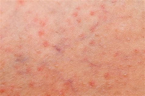 what is folliculitis and how is it treated