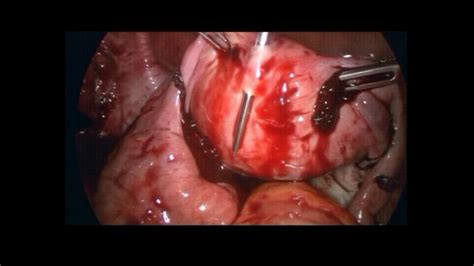 T Lift Manipulation Of The Uterus Of A Virgin Patient In