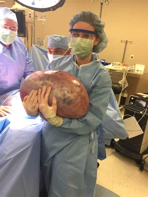 Woman Discovers 50 Lb Weight Gain Is An Ovarian Cyst