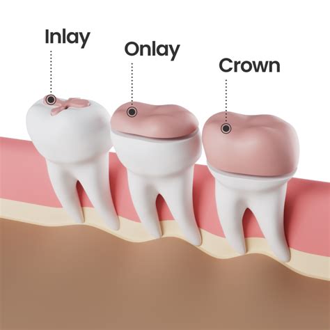 dental inlays onlays materials procedure costs