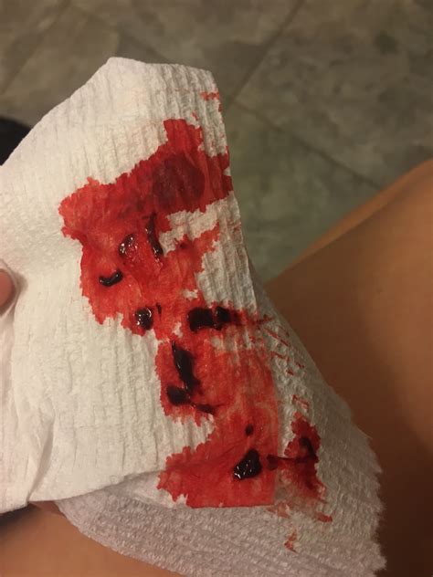 is it normal to bleed at 6 7 weeks pregnant