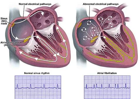 Atrial Fibrillation Pathway