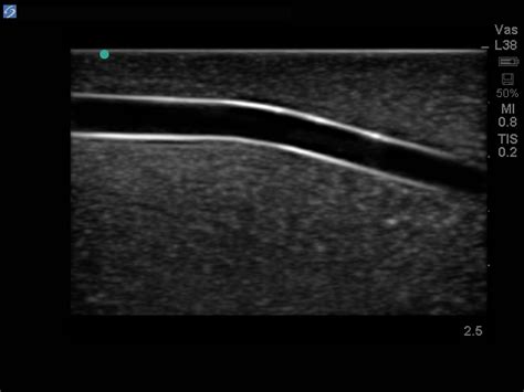 leg femoral  saphenous vein venous access ultrasound training model  dvt option