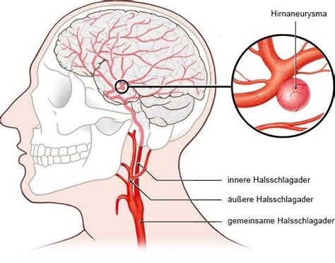 hirnaneurysma gesundheitsinformationde