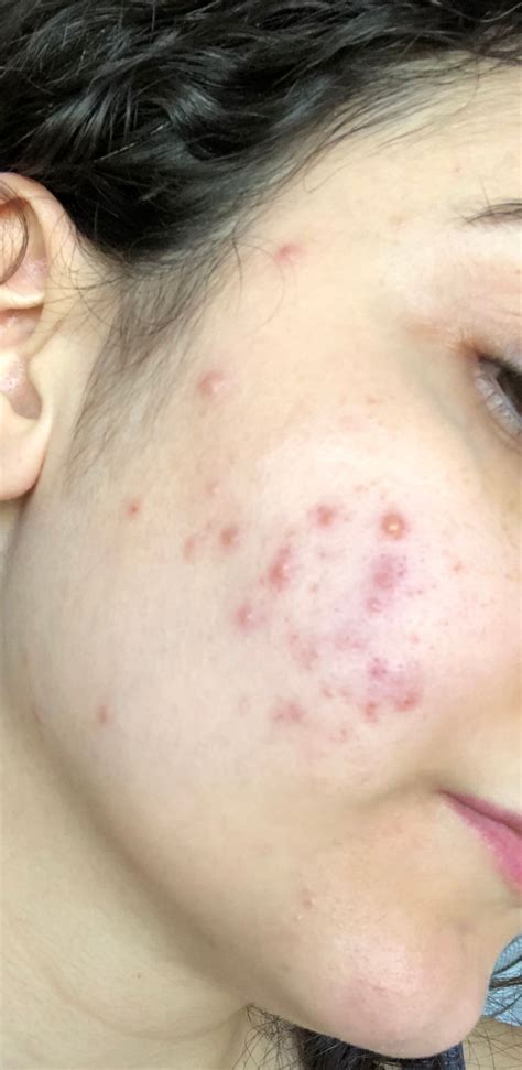 Red Bumps On Cheeks Beauty Insider Community