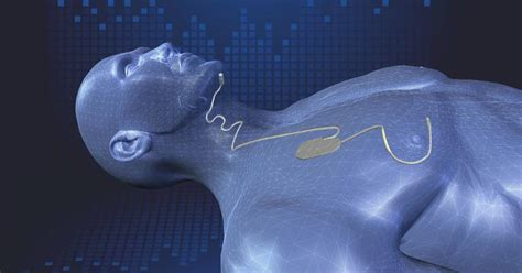 sleep apnea patient finds rest  implant device  saved  life cbs news