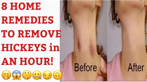 8 home remedies to remove hickeys or love bites in less than an hour d
