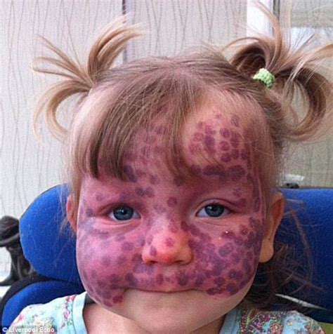 5 year old girl battles rare condition that causes polka dot spots to