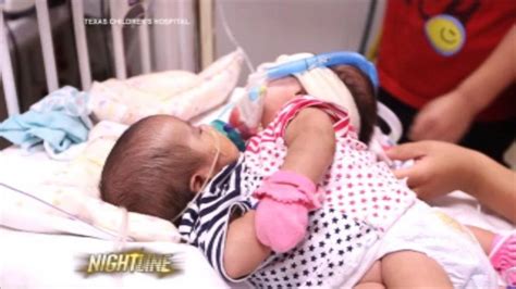 Conjoined Twins Living Heart To Heart Undergo Separation Surgery