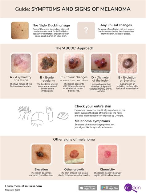 melanoma symptoms  signs extensive guide