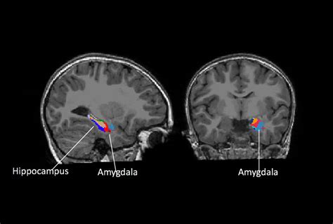 enlarged amygdala  forecast anxiety depression  autistic children