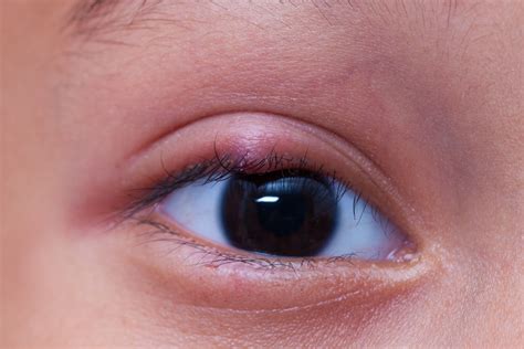 natural remedies  common eye problems