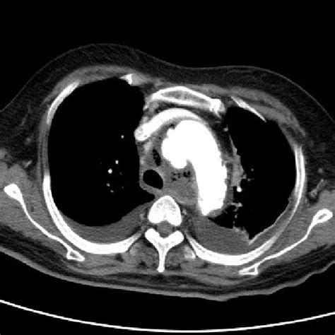 Appearance Of Chest 1 Year After Minimally Invasive Repair