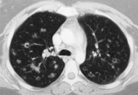 nonresolving pulmonary infiltrates in a smoker shm abstracts
