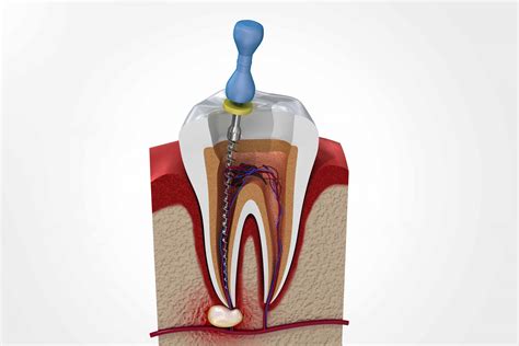 root canal treatment diagnosis treatment  benefits
