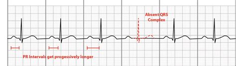 ekg learn   types  atrioventricular blocks leveluprn