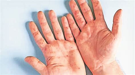 hand foot and mouth disease hfmd self limiting no need to panic say
