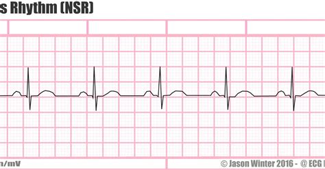Printable Ekg Strips That Are Old Fashioned Harper Blog