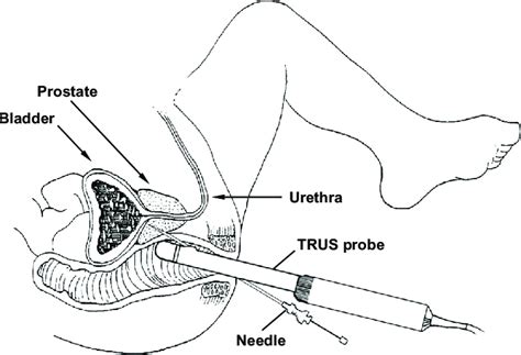 schematic drawing of a biopsy procedure illustrates how a forward
