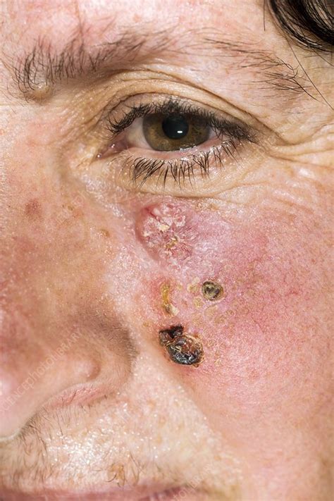 basal cell skin cancer   face stock image  science photo library