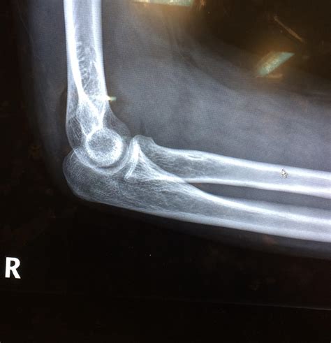 find  signs   fracture   elbow     potato quality
