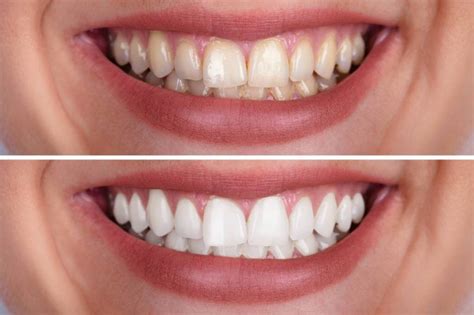 teeth whitening work     sensitivity