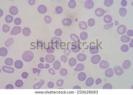 thalassemia stock  images pictures shutterstock