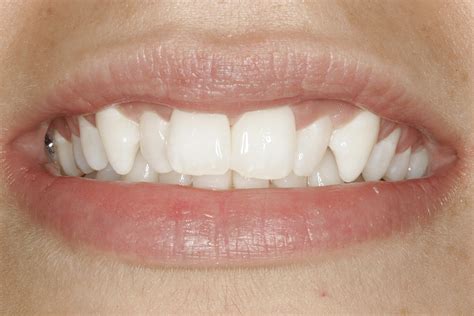 teeth  center  advanced dentistrys blog