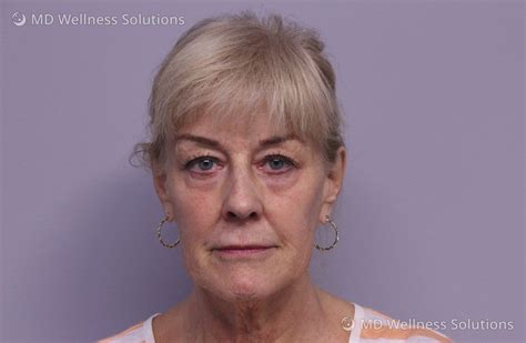 65 74 year old woman before and after dermal filler treatment — md