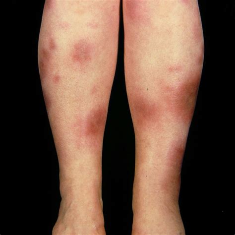 interface dermatitis id reaction overview