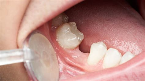 options  fix missing teeth advanced dental care  anderson