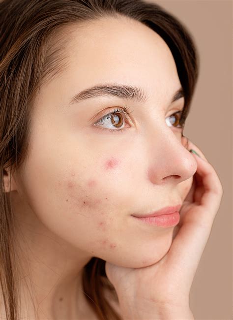 pimple acne      pimple acne stock  hd images