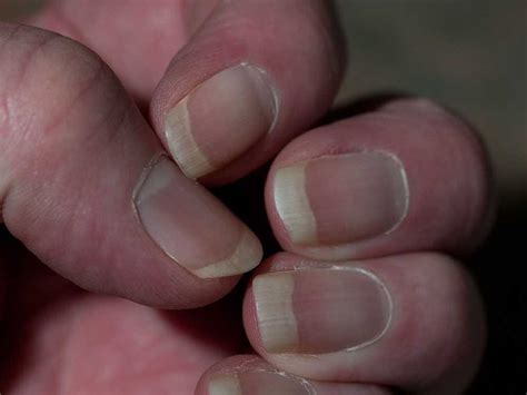 what doctors can tell about your health just by looking at your nails