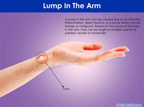 lump   arm     treated  removed