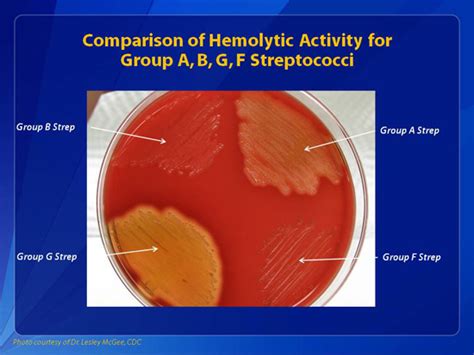 Hemolytic Strep Group B Mature Milf